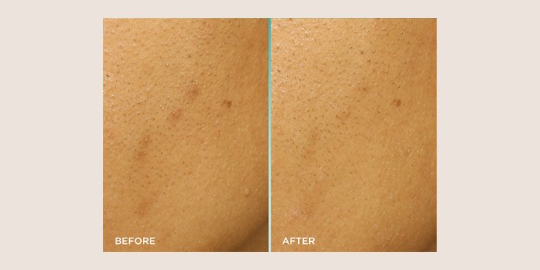 In Article Banner What Is A Chemical Peel Bright Reveal Snake Peel Exfoliant 01